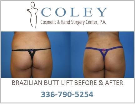 What are the typical results from buttock lift surgery?