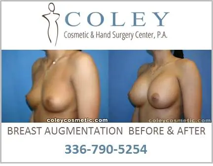 Breast Augmentation Before and After Pictures Greensboro, NC