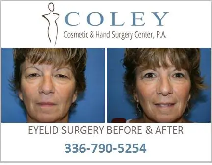 Blepharoplasty Before and After Pictures Greensboro, NC