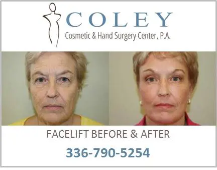 Facelift Before and After Pictures Greensboro, NC
