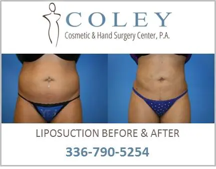 Liposuction Before and After Pictures Greensboro, NC