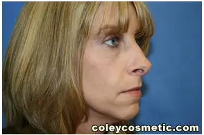 Facelift Before and After Pictures Greensboro, NC