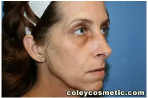 Facelift Before and After Pictures Greensboro, NC