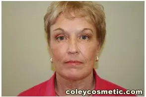 Facelift Before and After Pictures Greensboro, NC