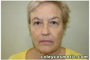 Facelift Before and After Pictures Greensboro, NC