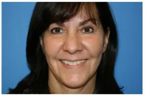 Facelift Before and After Pictures Greensboro, NC
