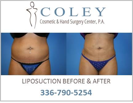 liposuction greensboro nc body performed