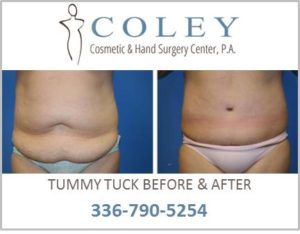 Tummy Tuck Before and After Pictures in Greensboro, NC