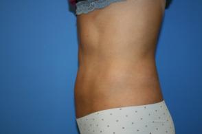 CoolSculpting Before and After Pictures Greensboro, NC