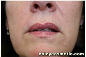 Lip Augmentation Before and After Pictures Greensboro, NC