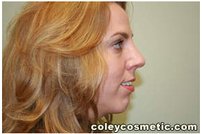 Chin Implants Before and After Pictures Greensboro, NC