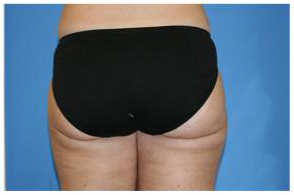 Liposuction Before and After Pictures Greensboro, NC