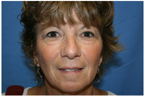 Blepharoplasty Before and After Pictures Greensboro, NC