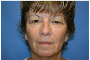 Blepharoplasty Before and After Pictures Greensboro, NC