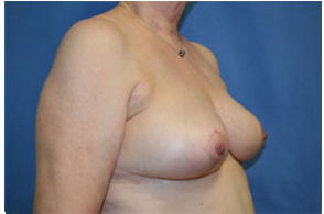 Breast Lift Before and After Pictures Greensboro, NC