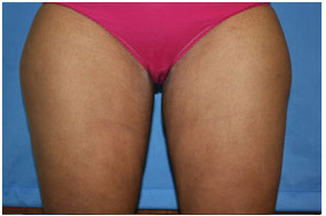 Liposuction Before and After Pictures Greensboro, NC