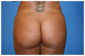 Brazilian Butt Lift Before and After Pictures Greensboro, NC