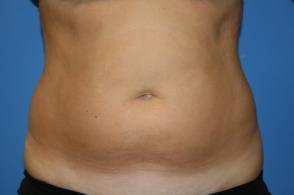 CoolSculpting Before and After Pictures Greensboro, NC