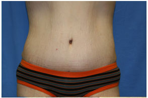 Tummy Tuck Before and After Pictures Greensboro, NC