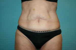Tummy Tuck Before and After Pictures Greensboro, NC