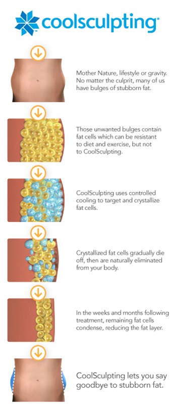 Coolsculpting in Greensboro NC a nonsurgical procedure to eliminate fat, for good, without downtime