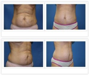 Liposuction Before and After Pictures Burlington, NC