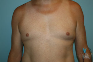 Male Breast Reduction Before and After Pictures in Greensboro, NC