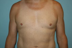 Male Breast Reduction Before and After Pictures in Greensboro, NC