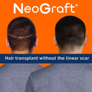 Hair Transplant without the linear scar