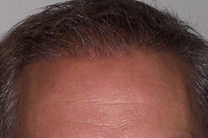 Hair Restoration Before and After Pictures Greensboro, NC