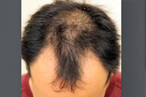 Hair Restoration Before and After Pictures Greensboro, NC