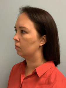 Chin Implants Before and After Pictures Greensboro, NC