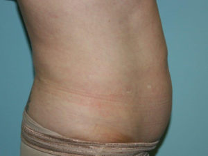 CoolSculpting Before and After Pictures in Greensboro, NC