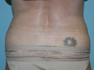 CoolSculpting Before and After Pictures in Greensboro, NC