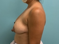 Breast Lift Before and After Pictures in Greensboro, NC