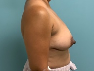 Breast Lift Before and After Pictures in Greensboro, NC