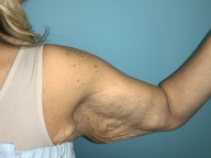 Arm Lift Before and After Pictures Greensboro, NC