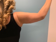 Arm Lift Before and After Pictures Greensboro, NC